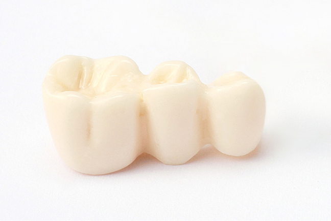 傷口が塞がったら、インプラントの上に人工歯を装着します。