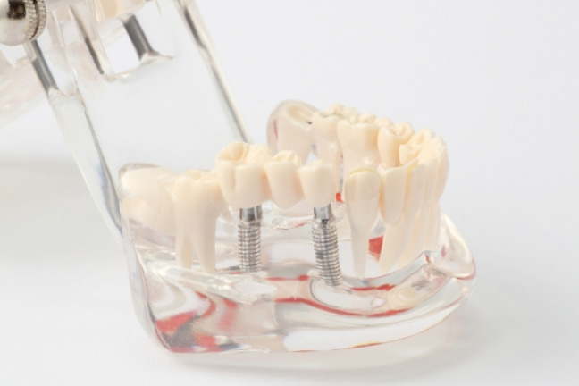 当院のインプラント治療