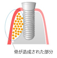 GBR法（骨再生誘導法）